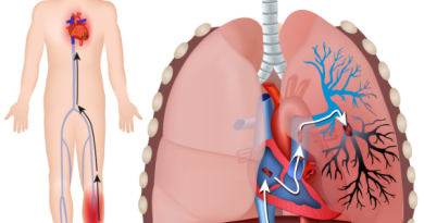 Sobanukirwa n’indwara ya “pulmonary embolism” indwara mbi yibasira abagore batwite