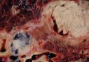 Ubuzima: Ikwirakwira rya cancer mu mubiri ( metastasis)) rikorwa gute ?