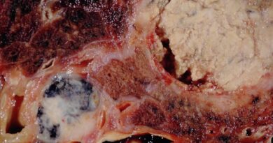Ubuzima: Ikwirakwira rya cancer mu mubiri ( metastasis)) rikorwa gute ?